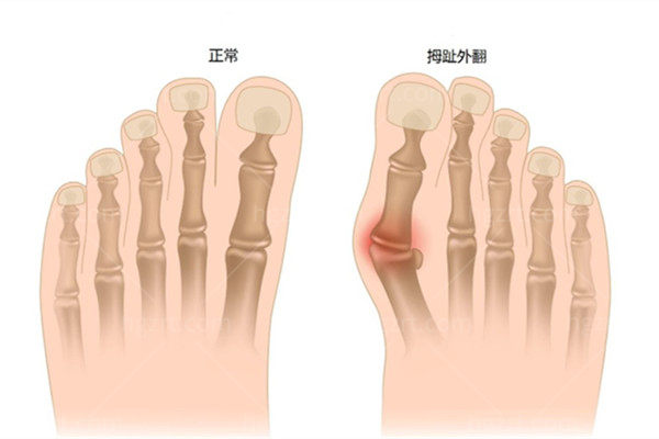 正常脚骨和拇外翻 正常脚骨和拇外翻