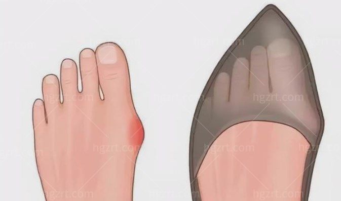 穿尖头高跟鞋易导致拇外翻 穿尖头高跟鞋易导致拇外翻