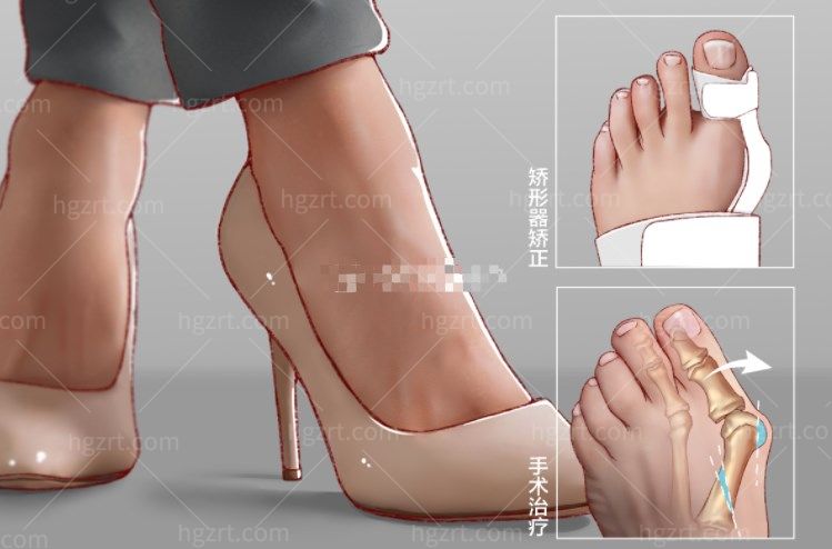 拇外翻治疗方式 拇外翻治疗方式