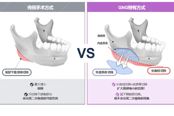 韩国轮廓哪里做得好?当地亲评韩国gng整形医院轮廓三件套绝绝子! 韩国轮廓哪里做得好?当地亲评韩国gng整形医院轮廓三件套绝绝子!