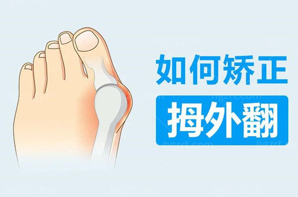 武汉拇外翻手术哪家医院好 武汉拇外翻手术哪家医院好