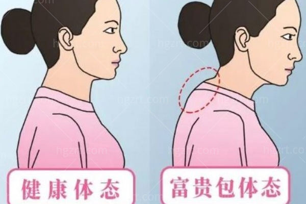 富贵包抽脂好还是切除好 富贵包抽脂好还是切除好