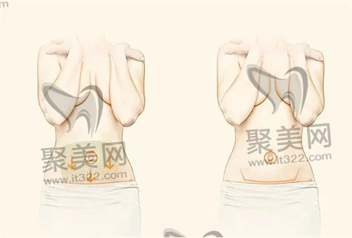 吸脂手术