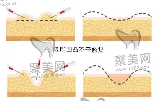 影响腰腹环吸价格的因素有哪些？