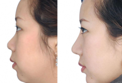 假体隆鼻后鼻夹要带多久？恢复期注意事项有哪些？