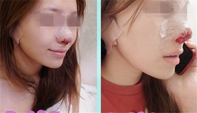 注射隆鼻收费价目表_具体多少钱? 注射隆鼻收费价目表_具体多少钱?