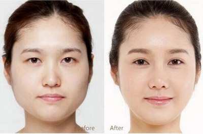 北京燕郊割双眼皮手术要多少钱? 北京燕郊割双眼皮手术要多少钱?