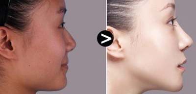 流行的微创除皱手术都有哪些？专家解读