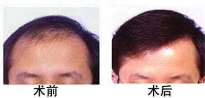 种植毛发治疗手术的花销是否可以上几万呢 种植毛发治疗手术的花销是否可以上几万呢