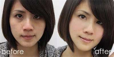 做腰腹吸脂手术，术后效果很理想