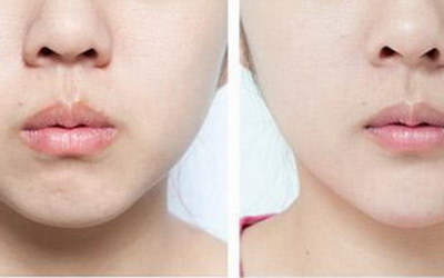 自体脂肪丰太阳穴收费价目表，大约多少钱？