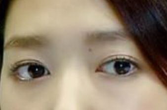 溶脂去眼袋价格费用【怎样计算费用】 溶脂去眼袋价格费用【怎样计算费用】