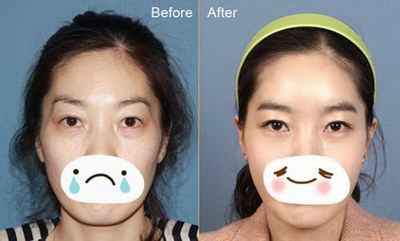 中山丰太阳穴整形专家哪个比较专业? 中山丰太阳穴整形专家哪个比较专业?