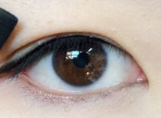 溶脂去眼袋优惠价格，一般要多少钱？