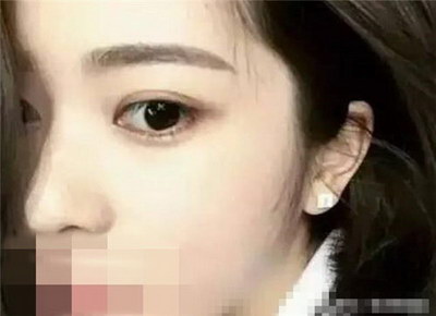 玻尿酸垫眉弓活动优惠价格【如何收费】