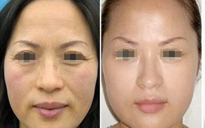 玻尿酸丰卧蚕整形价格,大约要多少钱? 玻尿酸丰卧蚕整形价格,大约要多少钱?