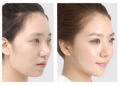 注射隆鼻价格一览表,大概要花多少钱?