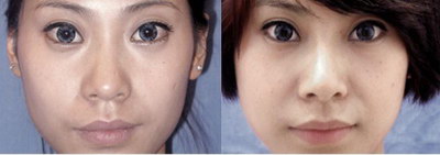 注射隆鼻价格费用_要花多少钱? 注射隆鼻价格费用_要花多少钱?