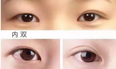 溶脂去眼袋的费用_具体需要多少费用？