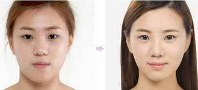 眼部热玛吉费用如何?