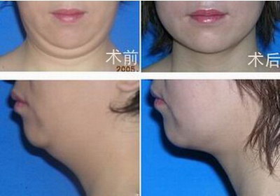 丰太阳穴大约要多少钱? 丰太阳穴大约要多少钱?