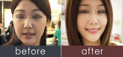 潍坊自体脂肪丰太阳穴整容医生哪个好？