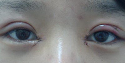 溶脂去眼袋价格费用【怎样计算费用】 溶脂去眼袋价格费用【怎样计算费用】