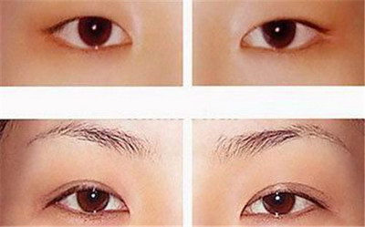 玻尿酸垫眉弓活动优惠价格【如何收费】