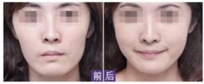 重庆下颌整形整容医生哪个好？