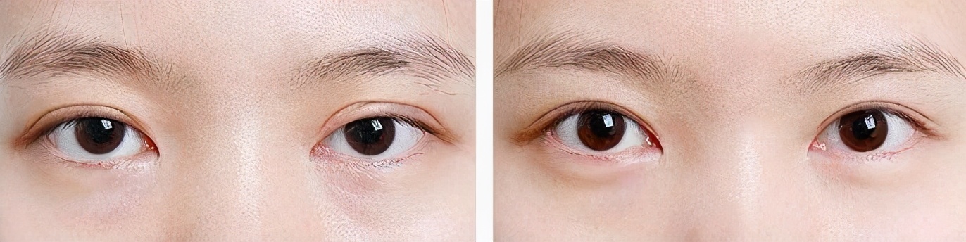 什么样的双眼皮需要考虑做修复呢？有哪些注意事项？