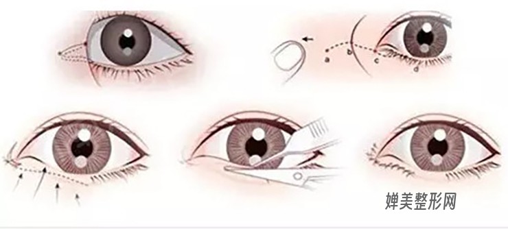 开眼角手术恢复期有多久？开眼角后怎么护理？