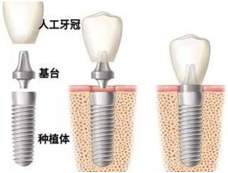 种植牙可能会造成哪些副作用 贵阳华美莫小红擅长口腔治疗