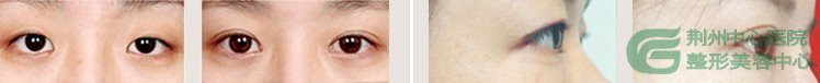 韩式双眼皮有哪几种