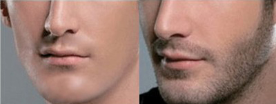 胡须种植前后对比图