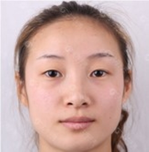 上海华美佀同帅双眼皮案例_切开双眼皮+提肌+内眼角_术后30天完整蜕变过程