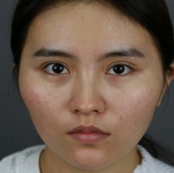 上海首尔丽格洪性范磨骨的个人真实案例，颧骨内推+磨下颌角+脂肪填充术120天日志