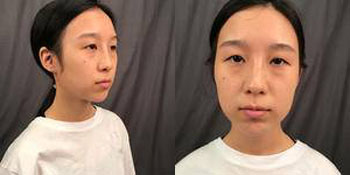 上海华美张朋做双眼皮修复怎么样_切开双眼皮+开眼角+提肌_眼综合120天恢复案例