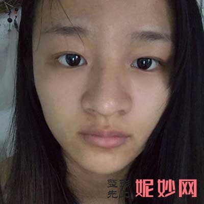 北京协和医院整形美容外科做硅胶隆鼻案例效果对比图分享