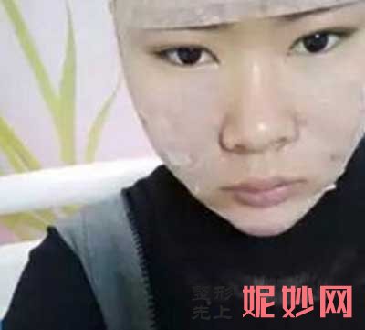 北京协和医院整形美容外科朱琳医生做下巴抽脂案例分享