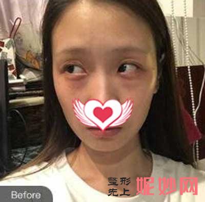 找北京联合丽格陈万芳做全脸脂肪填充，术后60天恢复效果图分享