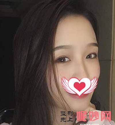 找北京联合丽格陈万芳做全脸脂肪填充，术后60天恢复效果图分享