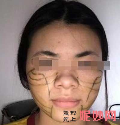 找北京联合丽格杨大平做了面部提升手术，感觉走向人生巅峰了