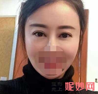 北京联合丽格找陈翠云做玻尿酸丰苹果肌，真实对比图分享