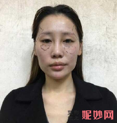 北京联合丽格陈万芳为我做的自体脂肪面部填充，效果真的太棒了