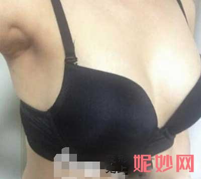 找八大处整形医院刘春军做自体脂肪隆胸，术后半年效果图分享