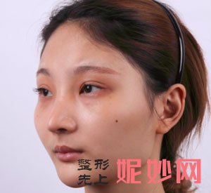 到上海华美找李志海做的V-LINE瓜子脸手术，术后40天脸精致又小巧