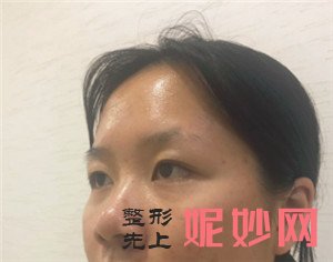 北京圣嘉荣周松医生做肋软骨隆鼻的技术怎么样？真人案例对比图分享