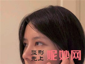 北京圣嘉荣周松医生做肋软骨隆鼻的技术怎么样？真人案例对比图分享
