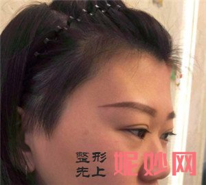 在北京圣嘉荣医疗美容医院做的鼻部多项怎么样？真人案例术前术后对比图分享！
