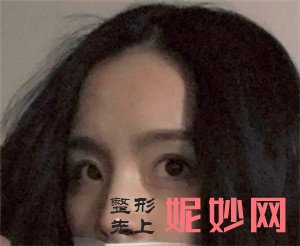 在北京正美医疗美容诊所找郑永生做的歪鼻矫正怎么样？真人案例分享！